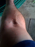 Allergy photo 2